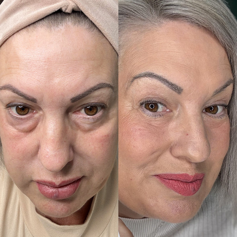 facial ice roller for puffy eyes and dark circles